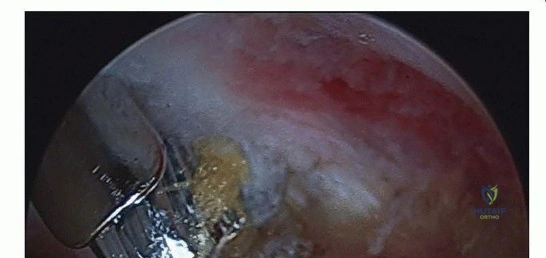 صورة طبية: تنظير مفصل الورك: حلول طفيفة التوغل لآلام الورك المزمنة في صنعاء مع الأستاذ الدكتور محمد هطيف