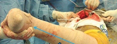 صورة طبية: إتقان توازن الأنسجة الرخوة لمفصل ورك صناعي مثالي: دليل شامل للمرضى مع الأستاذ الدكتور محمد هطيف