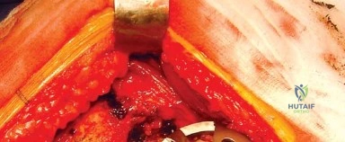 صورة طبية: النهج الخلفي الجانبي المتقدم: تحقيق أفضل النتائج في جراحة استبدال مفصل الورك الكلي مع الأستاذ الدكتور محمد هطيف في صنعاء