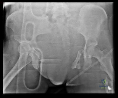 صورة طبية: دليل شامل لكسور وإصابات الجهاز الحركي: رعاية متقدمة في صنعاء مع الأستاذ الدكتور محمد هطيف