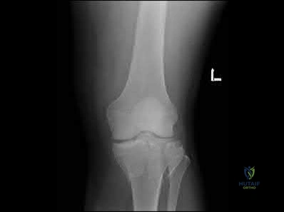 صورة طبية: دليل شامل لكسور وإصابات الجهاز الحركي: رعاية متقدمة في صنعاء مع الأستاذ الدكتور محمد هطيف