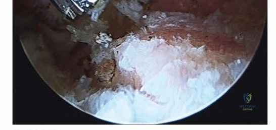صورة طبية: تنظير مفصل الورك: حلول طفيفة التوغل لآلام الورك المزمنة في صنعاء مع الأستاذ الدكتور محمد هطيف
