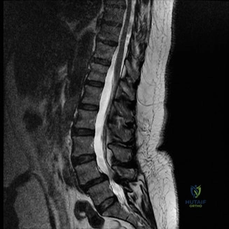 صورة طبية: حالات العمود الفقري: أهمية التشخيص الدقيق والعلاج الفعال مع الأستاذ الدكتور محمد هطيف في صنعاء