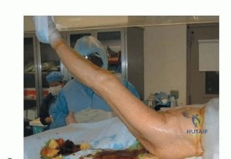 صورة طبية: نصف مفصل الورك: دليلك الشامل لدواعي الاستخدام والأنواع في صنعاء