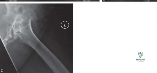 صورة طبية: استبدال مفصل الورك الكلي الناجح في خلل التنسج النمائي للورك: دليل شامل من الأستاذ الدكتور محمد هطيف