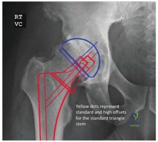 صورة توضيحية لـ سيقان مفصل الفخذ المسامية الموسعة: نجاح مثبت وتثبيت فائق لمفاصل ورك تدوم طويلاً في صنعاء مع الأستاذ الدكتور محمد هطيف