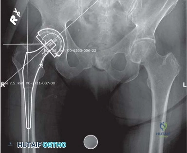 صورة توضيحية لـ المدخل الخلفي الجانبي لجراحة استبدال مفصل الورك الكلي: دليل شامل للمرضى في صنعاء مع الأستاذ الدكتور محمد هطيف