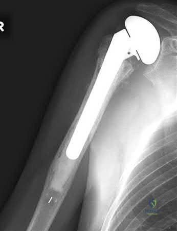 صورة طبية: دليل شامل لكسور وإصابات الجهاز الحركي: رعاية متقدمة في صنعاء مع الأستاذ الدكتور محمد هطيف