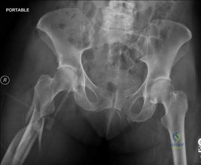 صورة طبية: دليل شامل لكسور وإصابات الجهاز الحركي: رعاية متقدمة في صنعاء مع الأستاذ الدكتور محمد هطيف