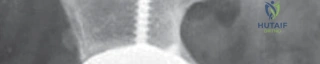 توضيح طبي: الكأس الحقي غير الإسمنتي: دليل شامل لمرضى استبدال مفصل الورك مع الأستاذ الدكتور محمد هطيف