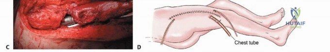 صورة طبية: استئصال عظم الفخذ الكلي والقريب مع الأطراف الصناعية الداخلية: أمل جديد بعد البتر