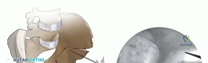 صورة طبية: استعادة صحة مفصل الفخذ جراحة قطع العظم الحوضي لعلاج خلل التنسج الحُقّي في صنعاء