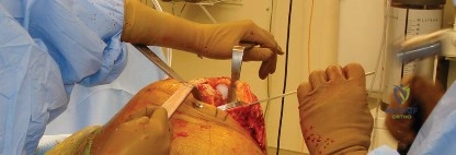 تحديات التثبيت العظمي
