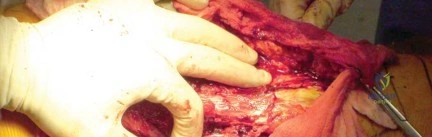 صورة طبية: استبدال مفصل الورك لإنقاذ حالات فشل تثبيت كسور الورك: حل فعال لاستعادة الحركة