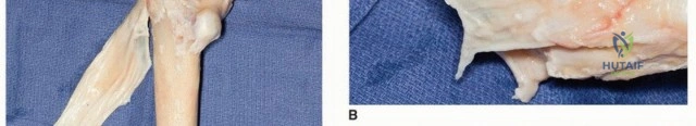 توضيح طبي: إعادة بناء الجزء العلوي من عظم الفخذ: تقنيات الطعم العظمي الاصطناعي والمفصل الداخلي مع الأستاذ الدكتور محمد هطيف في صنعاء
