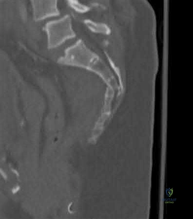 صورة طبية: دليل شامل لكسور وإصابات الجهاز الحركي: رعاية متقدمة في صنعاء مع الأستاذ الدكتور محمد هطيف