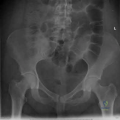 صورة طبية: دليل شامل لكسور وإصابات الجهاز الحركي: رعاية متقدمة في صنعاء مع الأستاذ الدكتور محمد هطيف