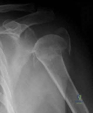 صورة طبية: دليل شامل لكسور وإصابات الجهاز الحركي: رعاية متقدمة في صنعاء مع الأستاذ الدكتور محمد هطيف