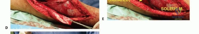 صورة توضيحية لـ معالجة الأورام المعقدة في قصبة الساق القريبة حلول الحفاظ على الأطراف