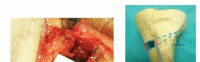 صورة طبية: قطع عظم الظنبوب العالي: إعادة محاذاة الركبة لتخفيف دائم لآلامها مع الأستاذ الدكتور محمد هطيف