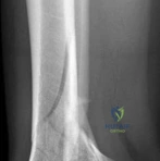 FOR DOCTORS PROXIMAL HUMERAL FRACTURES Extraarticular 2-Part, Greater Tuberosity, Displaced Treatment Screw fixation