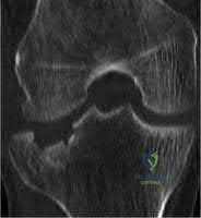 صورة طبية: دليل شامل لكسور وإصابات الجهاز الحركي: رعاية متقدمة في صنعاء مع الأستاذ الدكتور محمد هطيف