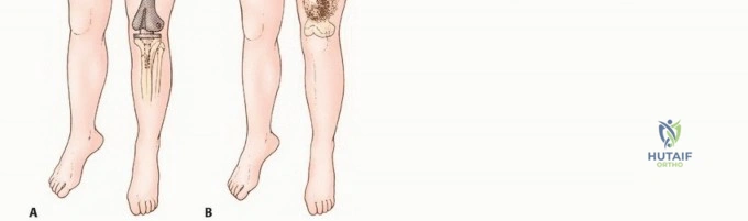 صورة توضيحية لـ بتر فوق الركبة: دليل شامل للمرضى وخيارات التعافي مع الأستاذ الدكتور محمد هطيف