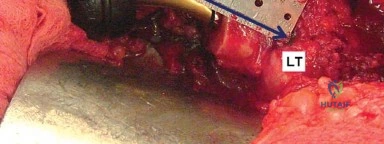 صورة طبية: إتقان توازن الأنسجة الرخوة لمفصل ورك صناعي مثالي: دليل شامل للمرضى مع الأستاذ الدكتور محمد هطيف