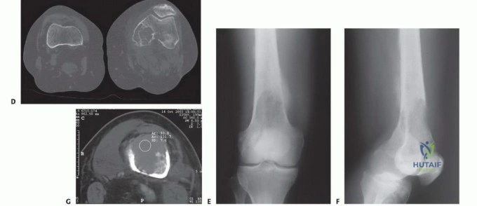 صورة توضيحية لـ النقائل العظمية الفخذية: دليل شامل للعلاج واستعادة الوظيفة مع الأستاذ الدكتور محمد هطيف في صنعاء