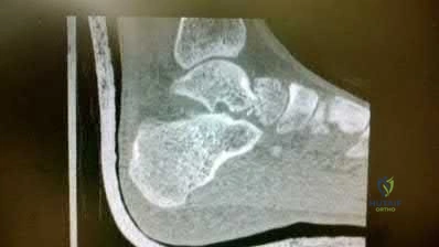 صورة طبية: دليل شامل لكسور وإصابات الجهاز الحركي: رعاية متقدمة في صنعاء مع الأستاذ الدكتور محمد هطيف