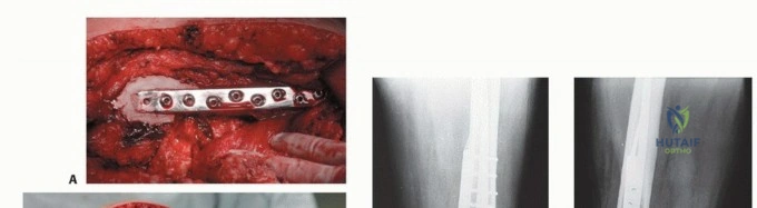 صورة طبية: النقائل العظمية الفخذية: دليل شامل للعلاج واستعادة الوظيفة مع الأستاذ الدكتور محمد هطيف في صنعاء