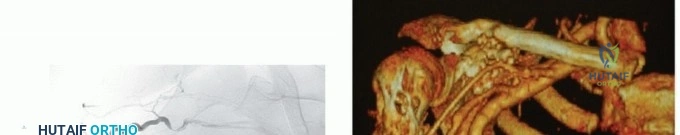 نموذج ثلاثي الأبعاد للكتف والورم