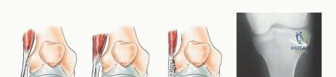 صورة طبية: استئصال أورام الشظية: دليل شامل للعلاج الحديث والحفاظ على الأطراف مع الأستاذ الدكتور محمد هطيف