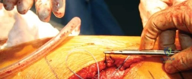 صورة طبية: المدخل الخلفي الجانبي لجراحة استبدال مفصل الورك الكلي: دليل شامل للمرضى في صنعاء مع الأستاذ الدكتور محمد هطيف