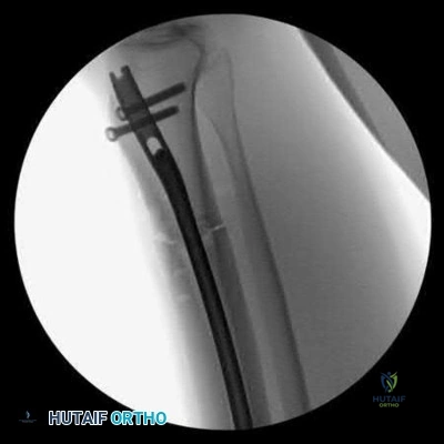صورة طبية: دليل شامل لكسور وإصابات الجهاز الحركي: رعاية متقدمة في صنعاء مع الأستاذ الدكتور محمد هطيف
