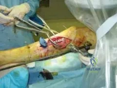 تفاصيل مرئية 66 - التثبيت الخارجي للقصبة: هكذا يتم وضع مسمارين لكسور معقدة