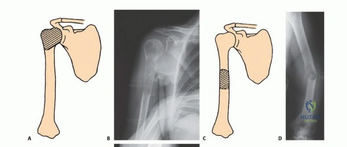 صورة توضيحية لـ جراحة نقائل عظم العضد: دليل شامل لاستعادة الوظيفة وتخفيف الألم في اليمن مع الأستاذ الدكتور محمد هطيف
