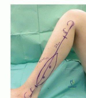 صورة طبية: ترقيع الشظية الوعائي الحر: حلول متقدمة لعيوب العظام المعقدة