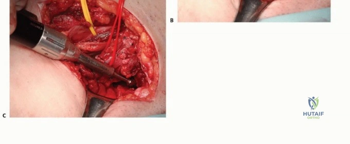 صورة توضيحية لـ جراحة نقائل الحوض: حل شامل لآلام العظام واستعادة الحركة مع الأستاذ الدكتور محمد هطيف