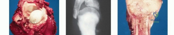صورة طبية: استئصال الجزء القريب من عظم العضد بتقنيات الحفاظ على الطرف: دليل شامل للمرضى مع الأستاذ الدكتور محمد هطيف