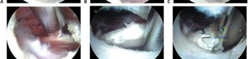 صورة طبية: توقف عن الطقطقة: الحفاظ على مفصل الورك وعلاج متلازمة الورك الطقطاق مع الأستاذ الدكتور محمد هطيف