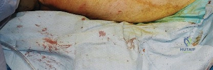 صورة طبية: النهج الخلفي لمفصل الورك: دليل شامل لاستعادة الحركة في صنعاء مع الأستاذ الدكتور محمد هطيف
