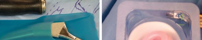 صورة طبية: المدخل الخلفي الجانبي لجراحة استبدال مفصل الورك الكلي: دليل شامل للمرضى في صنعاء مع الأستاذ الدكتور محمد هطيف