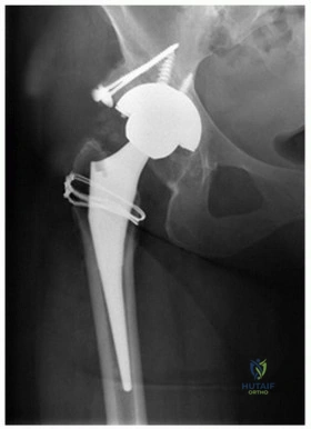 صورة توضيحية لـ قطع العظم المدوري الانزلاقي: دور حديث وتقنيات متطورة لاستعادة حركة الورك