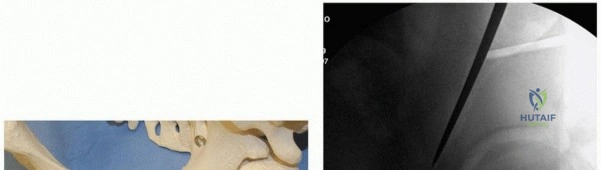 صورة توضيحية لـ جراحة قطع العظم حول الحُق وقطع عظم الفخذ: إعادة محاذاة مفصل الورك لراحة دائمة مع الأستاذ الدكتور محمد هطيف
