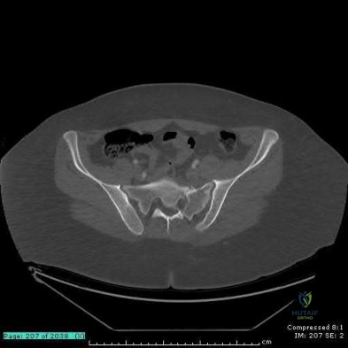 صورة طبية: دليل شامل لكسور وإصابات الجهاز الحركي: رعاية متقدمة في صنعاء مع الأستاذ الدكتور محمد هطيف