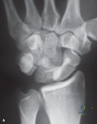 صورة بالرنين المغناطيسي (MRI) للرسغ تُظهر تفاصيل الأنسجة الرخوة