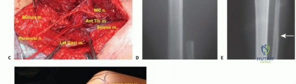 صورة طبية: استئصال أورام الشظية: دليل شامل للعلاج الحديث والحفاظ على الأطراف مع الأستاذ الدكتور محمد هطيف