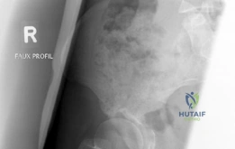 صورة توضيحية لـ قطع العظم حول الحقي بيرنيز: حل دائم لخلل التنسج الوركي واستعادة جودة الحياة