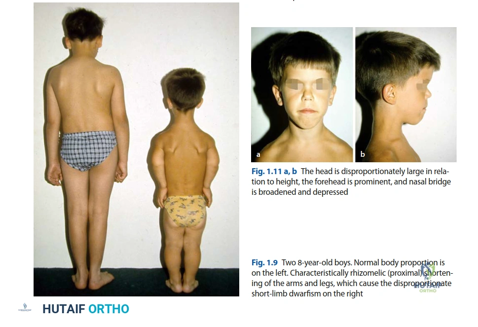 Illustration of orthopedic cases achondroplasia - Dr. Mohammed Hutaif